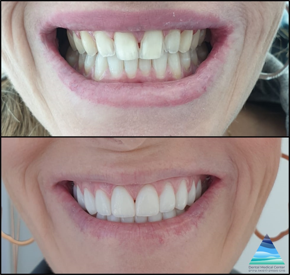 ציפויי שיניים